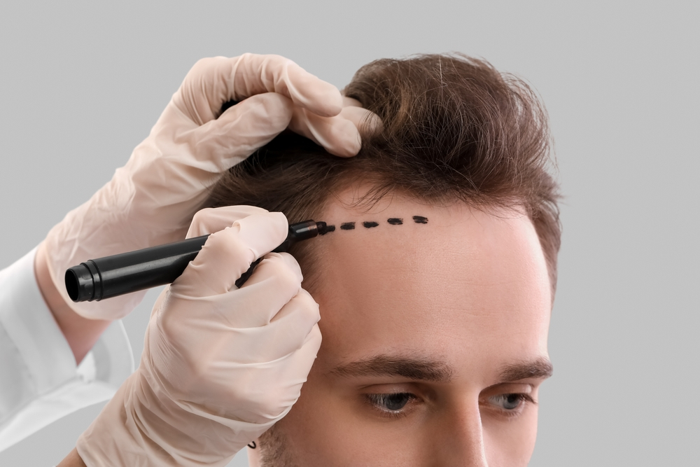 Erkek Tipi Saç Dökülmesi: Nedenleri ve Çözümleri
